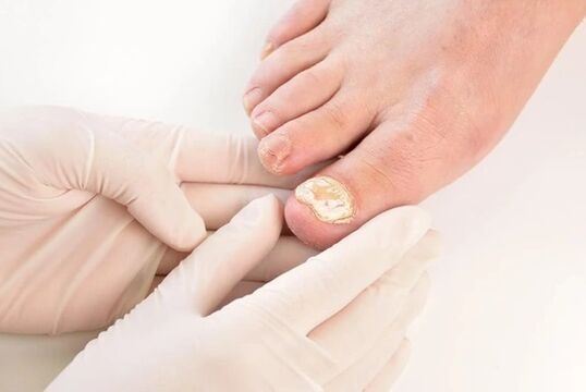 Doctor recommends Fungent to treat athlete's foot