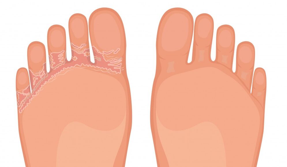 Fungent is effective against all types of foot fungus