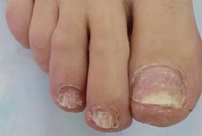 Nails severely affected by fungus