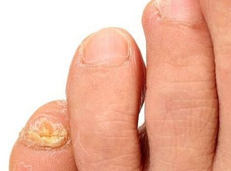 Fungus on the legs