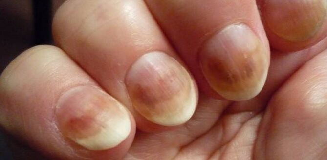 Nail bacteria infection