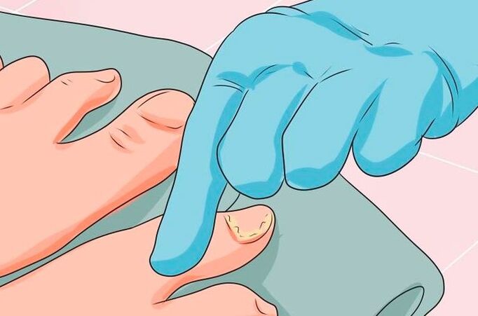 The first sign of nail fungic disease