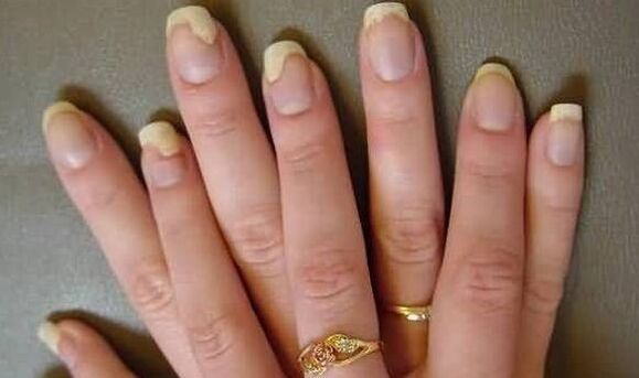 This is what nail fungus looks like in the deterioration stage