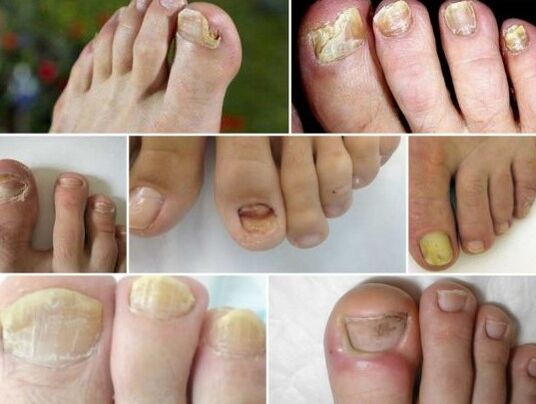 Various forms of nail fungi