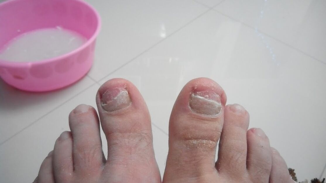 Fungus on the legs