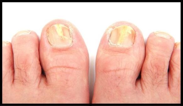 Nail fungus