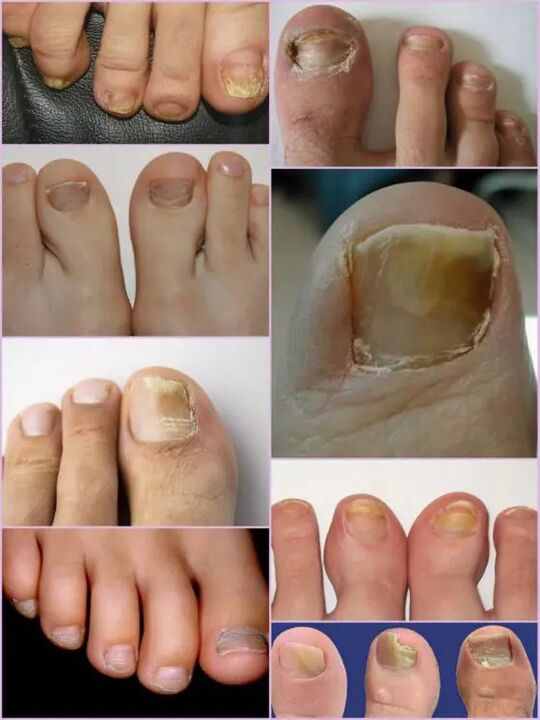 Variety of nail fungi