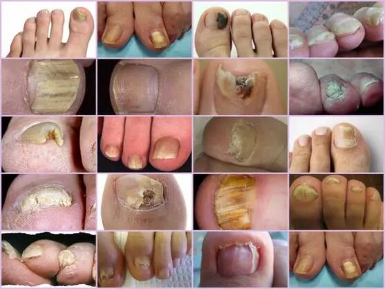 Various positioning on nails