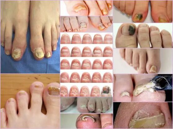 Various varieties of formicrobial diseases
