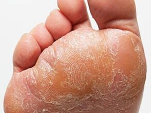Foot fungus