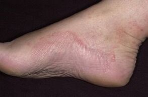 Fungal damage to feet