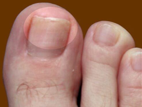 Fungal lesions