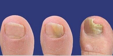 The development stage of nail fungi
